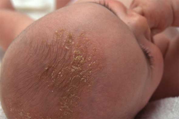 Membersihkan cradle cap